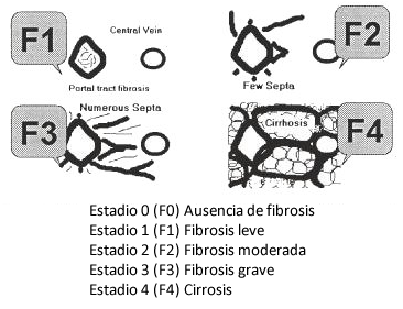 Esquema de fibrosis